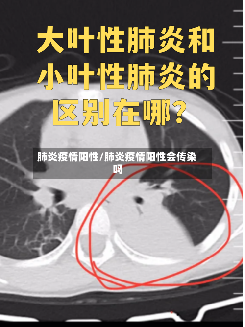 肺炎疫情阳性/肺炎疫情阳性会传染吗